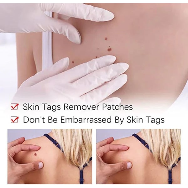 Skin Tag Remover Mole Wart Spot Pen Applicator Clear White Unisex Fast - Image 5