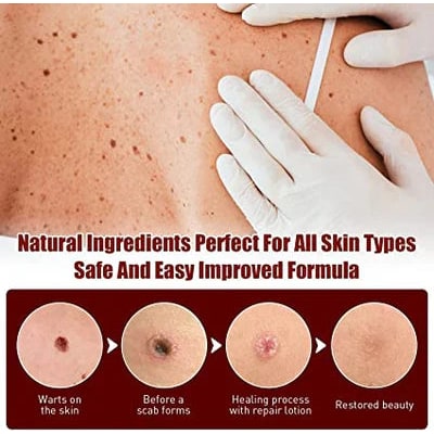 Skin Tag Remover Mole Wart Spot Pen Applicator Clear White Unisex Fast - Image 8