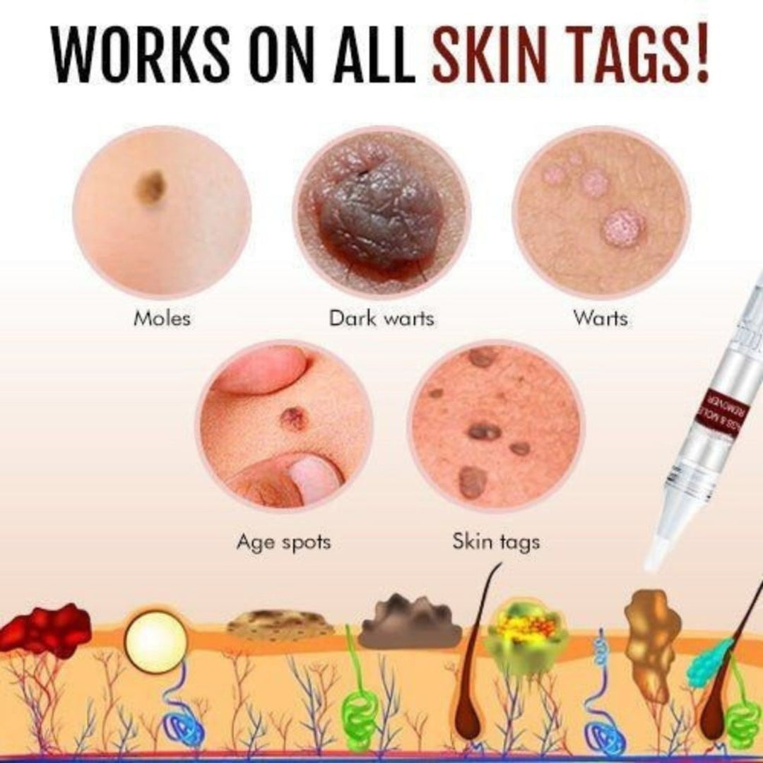 Skin Tag Remover Mole Wart Spot Pen Applicator Clear White Unisex Fast - Image 2
