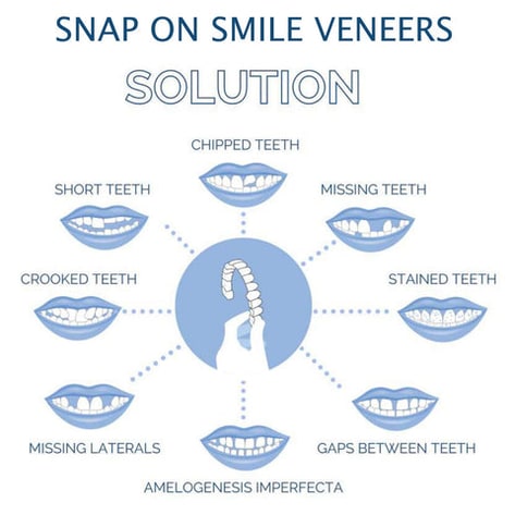 Snap On Veneers Instant Smile Moldable Upper Lower Arch Comfort Fit White - Image 6